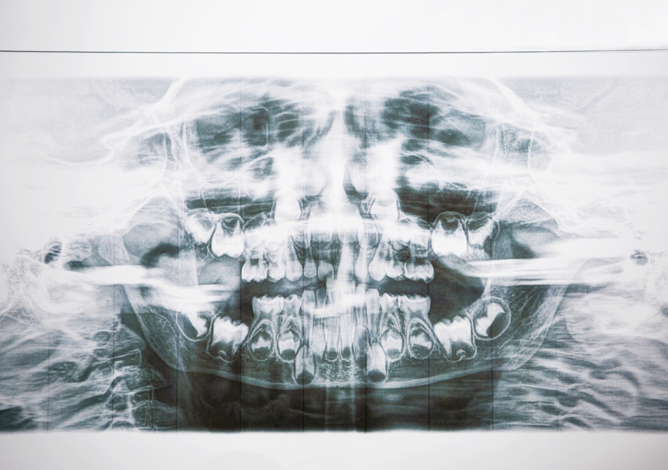 Zęby mleczne RTG - jak interpretować wyniki?